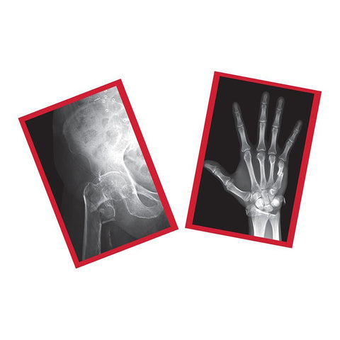 FIXED BONES X-RAYS